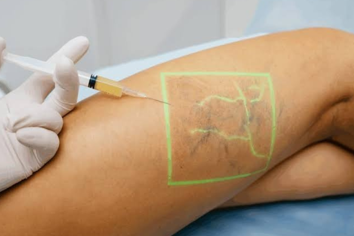 Escleroterapia